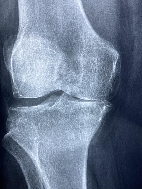 personal injury