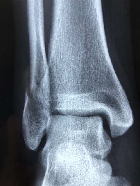 personal injury