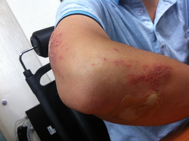 personal injury