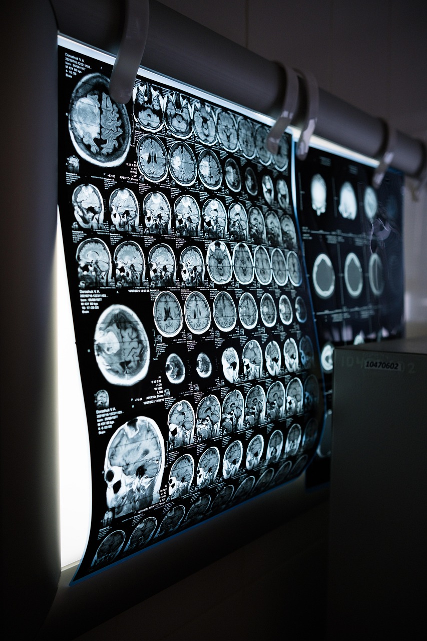 When to Hire Brain Injury Lawyer Phoenix: Serious Injuries, Legal Guidance